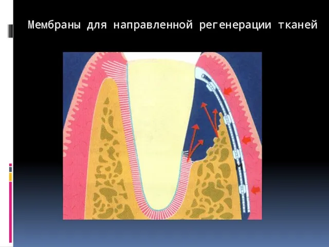 Мембраны для направленной регенерации тканей