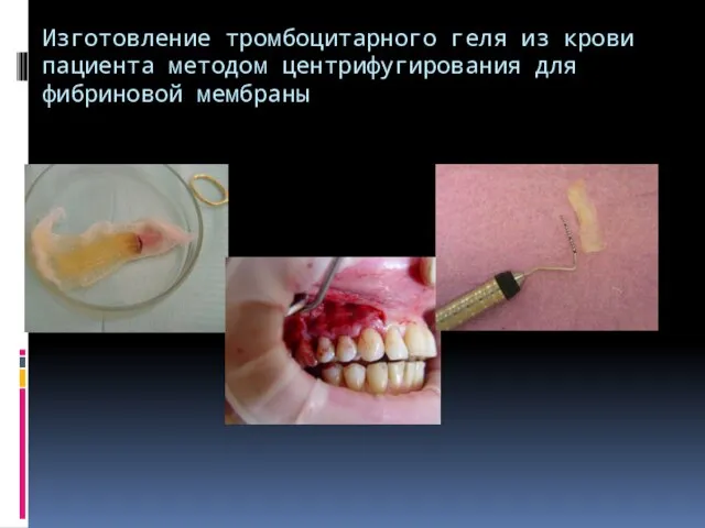 Изготовление тромбоцитарного геля из крови пациента методом центрифугирования для фибриновой мембраны