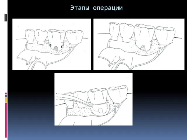 Этапы операции