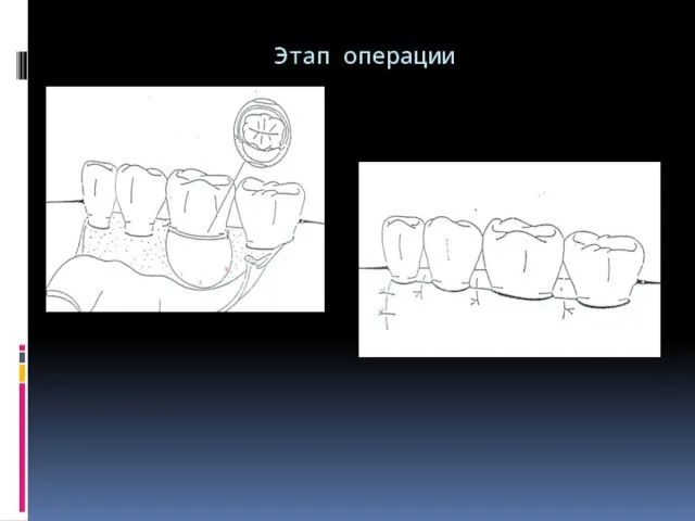 Этап операции