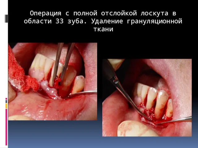 Операция с полной отслойкой лоскута в области 33 зуба. Удаление грануляционной ткани