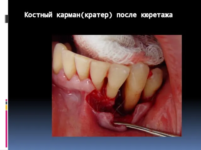 Костный карман(кратер) после кюретажа