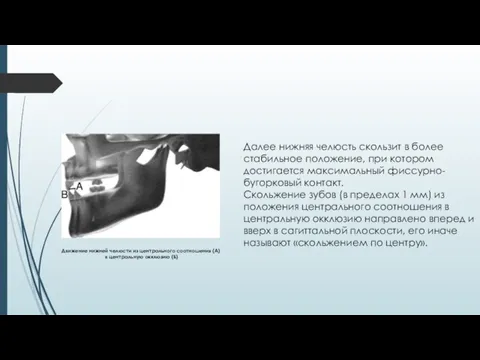 Далее нижняя челюсть скользит в более стабильное положение, при котором достигается максимальный