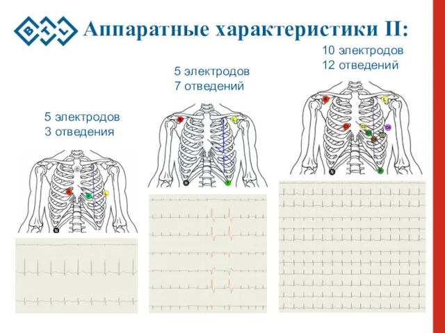 Аппаратные характеристики II: 5 электродов 3 отведения 5 электродов 7 отведений 10 электродов 12 отведений