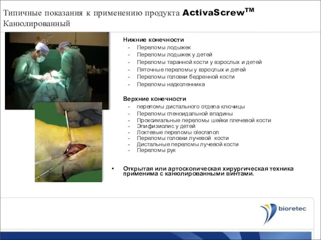Типичные показания к применению продукта ActivaScrewTM Канюлированный Нижние конечности Переломы лодыжек Переломы