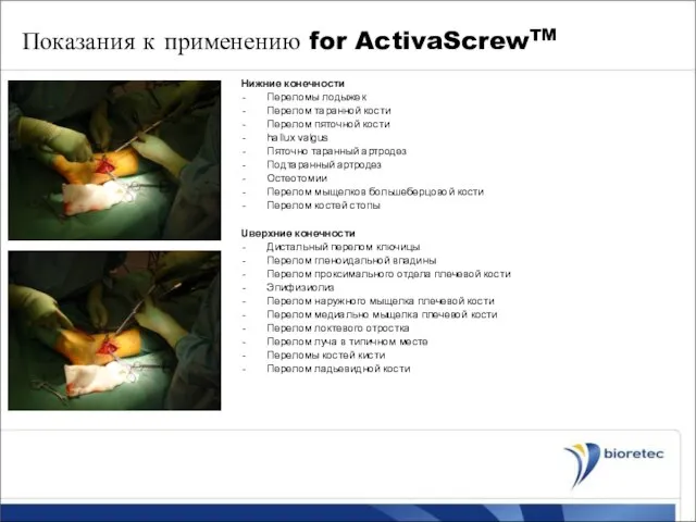 Показания к применению for ActivaScrewTM Нижние конечности Переломы лодыжек Перелом таранной кости