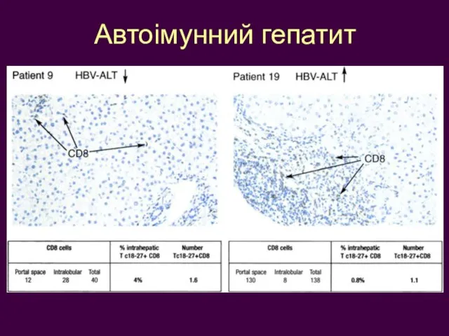 Автоімунний гепатит