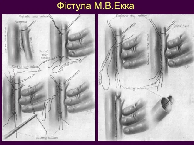 Фістула М.В.Екка