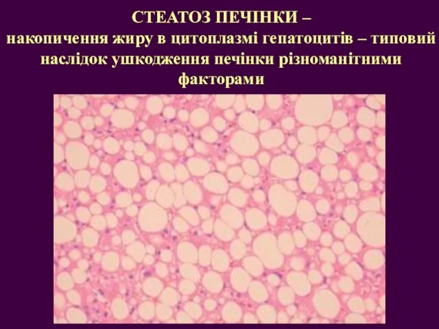 СТЕАТОЗ ПЕЧІНКИ – накопичення жиру в цитоплазмі гепатоцитів – типовий наслідок ушкодження печінки різноманітними факторами