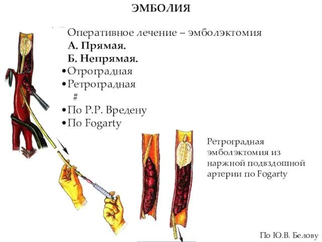 ЭМБОЛИЯ Оперативное лечение – эмболэктомия А. Прямая. Б. Непрямая. Отроградная Ретроградная #