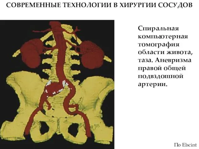 СОВРЕМЕННЫЕ ТЕХНОЛОГИИ В ХИРУРГИИ СОСУДОВ Спиральная компьютерная томография области живота, таза. Аневризма