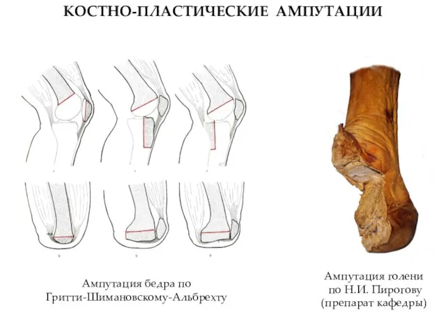 КОСТНО-ПЛАСТИЧЕСКИЕ АМПУТАЦИИ Ампутация бедра по Гритти-Шимановскому-Альбрехту Ампутация голени по Н.И. Пирогову (препарат кафедры)