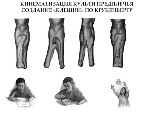 КИНЕМАТИЗАЦИЯ КУЛЬТИ ПРЕДПЛЕЧЬЯ СОЗДАНИЕ «КЛЕШНИ» ПО КРУКЕНБЕРГУ