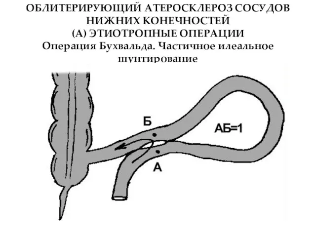 ОБЛИТЕРИРУЮЩИЙ АТЕРОСКЛЕРОЗ СОСУДОВ НИЖНИХ КОНЕЧНОСТЕЙ (А) ЭТИОТРОПНЫЕ ОПЕРАЦИИ Операция Бухвальда. Частичное илеальное шунтирование