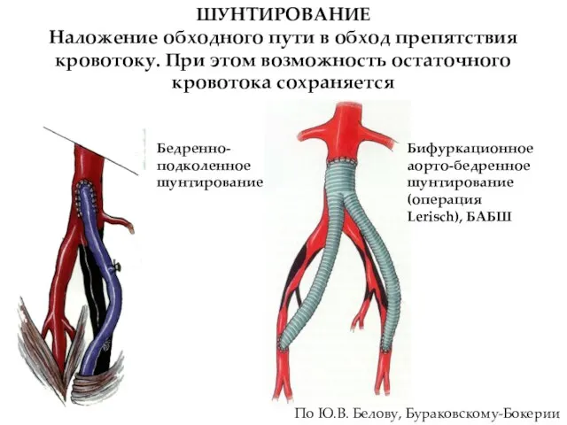 ШУНТИРОВАНИЕ Наложение обходного пути в обход препятствия кровотоку. При этом возможность остаточного