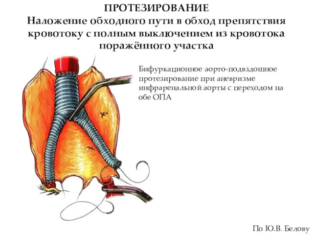 ПРОТЕЗИРОВАНИЕ Наложение обходного пути в обход препятствия кровотоку с полным выключением из