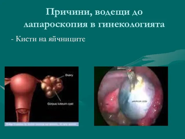 Причини, водещи до лапароскопия в гинекологията - Кисти на яйчниците