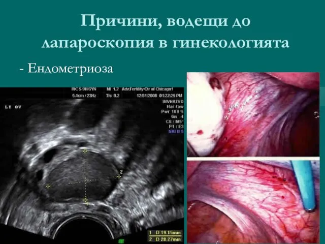 Причини, водещи до лапароскопия в гинекологията - Ендометриоза