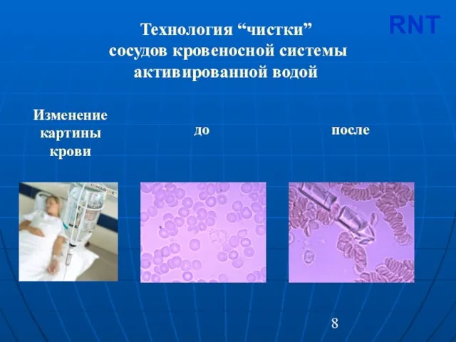 Изменение картины крови до после RNT Технология “чистки” сосудов кровеносной системы активированной водой