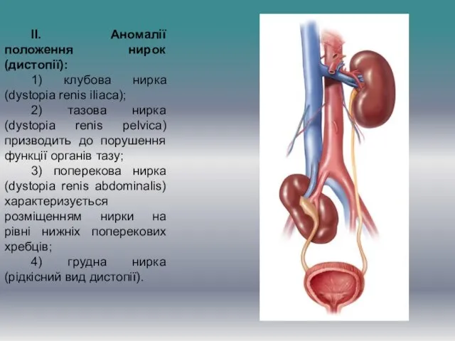 II. Аномалії положення нирок (дистопії): 1) клубова нирка (dystopia renis iliaca); 2)