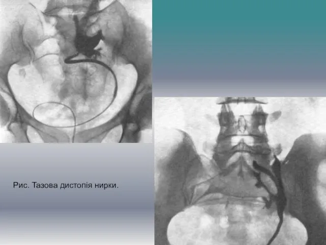 Рис. Тазова дистопія нирки.