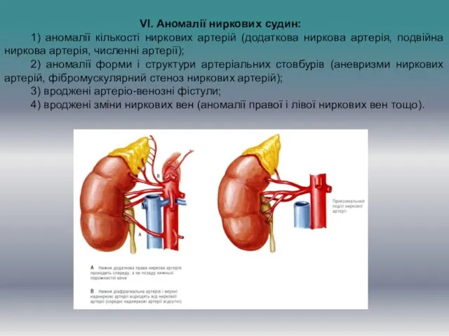 VI. Аномалії ниркових судин: 1) аномалії кількості ниркових артерій (додаткова ниркова артерія,