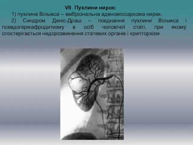 VII. Пухлини нирок: 1) пухлина Вільмса – ембріональна аденоміосаркома нирки. 2) Синдром