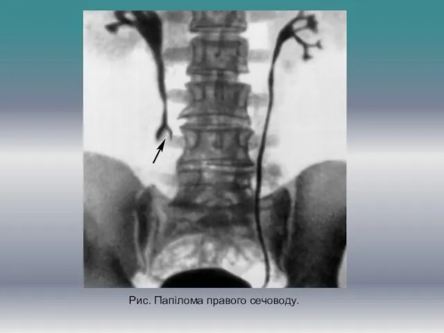 Рис. Папілома правого сечоводу.