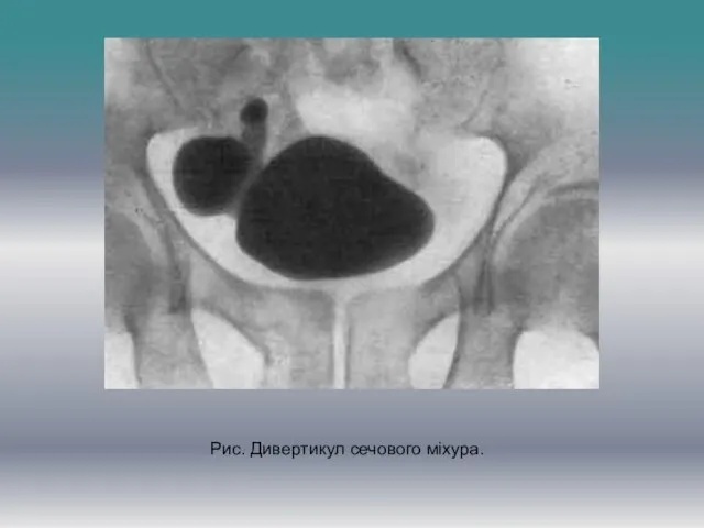 Рис. Дивертикул сечового міхура.