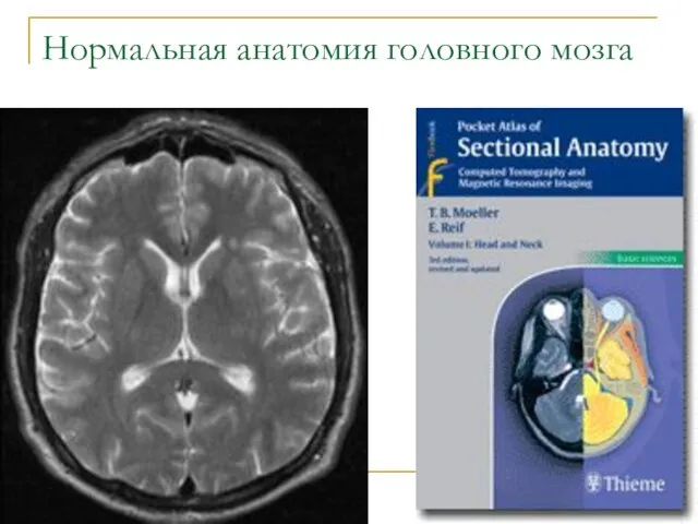 Нормальная анатомия головного мозга