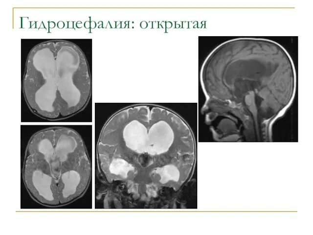 Гидроцефалия: открытая