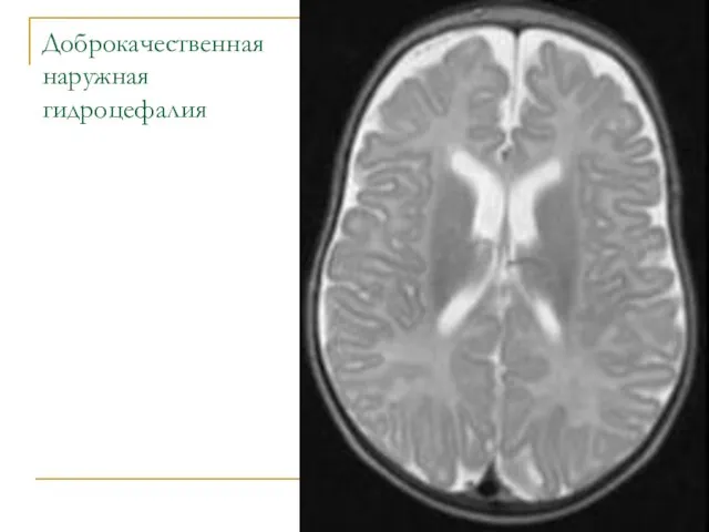 Доброкачественная наружная гидроцефалия