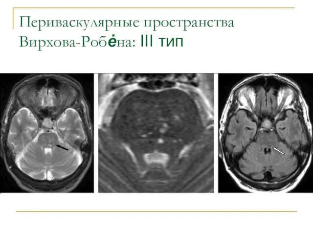 Периваскулярные пространства Вирхова-Робėна: III тип