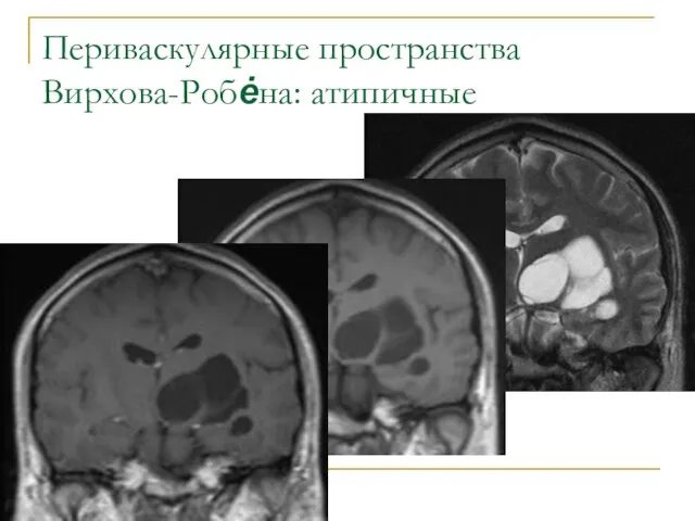 Периваскулярные пространства Вирхова-Робėна: атипичные