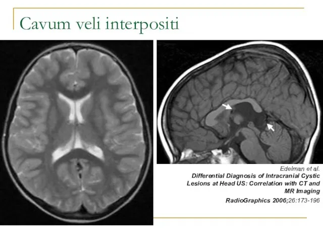 Cavum veli interpositi Edelman et al. Differential Diagnosis of Intracranial Cystic Lesions