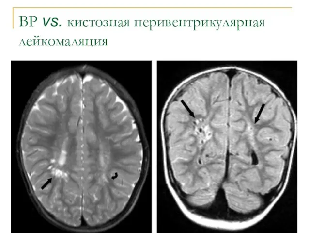 ВР vs. кистозная перивентрикулярная лейкомаляция