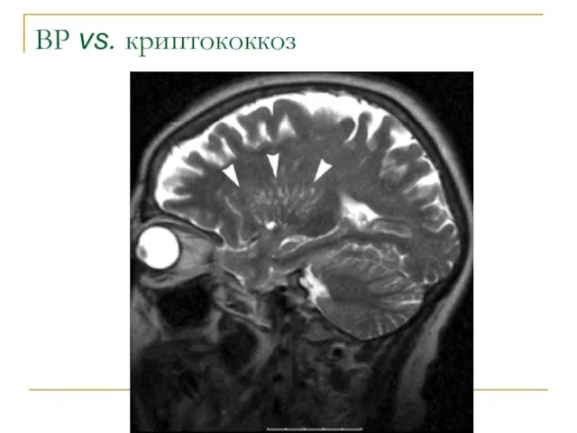 ВР vs. криптококкоз
