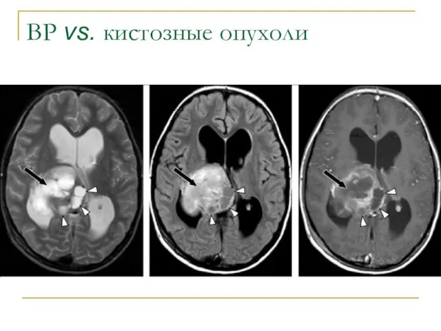 ВР vs. кистозные опухоли