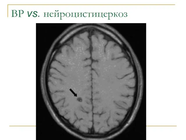 ВР vs. нейроцистицеркоз