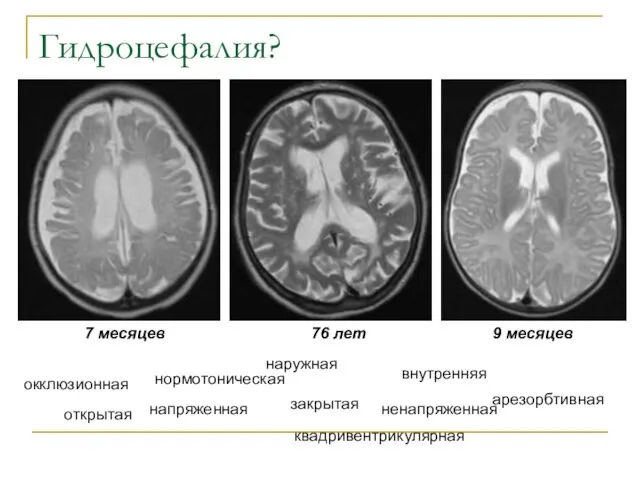 Гидроцефалия? открытая закрытая напряженная наружная ненапряженная внутренняя окклюзионная арезорбтивная нормотоническая 7 месяцев