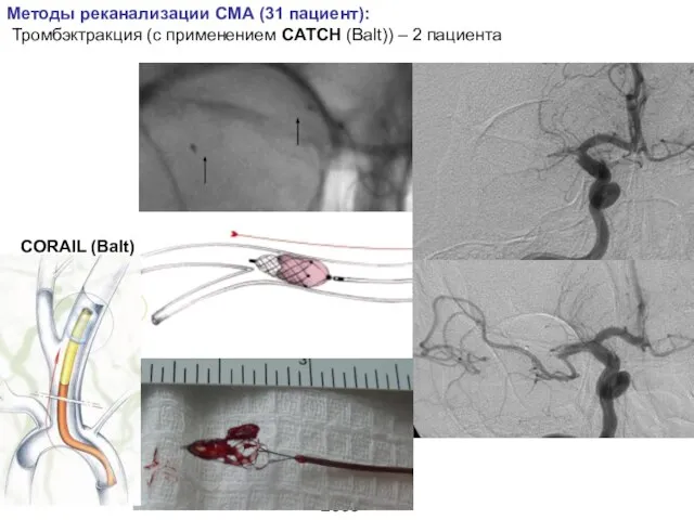 2009 Методы реканализации СМА (31 пациент): Тромбэктракция (с применением CATCH (Balt)) – 2 пациента CORAIL (Balt)