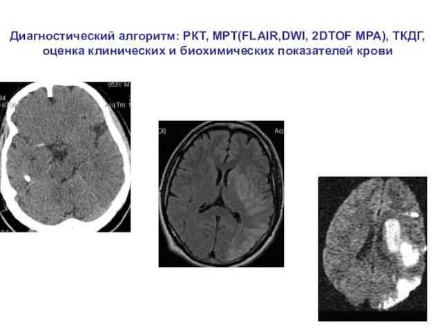 Диагностический алгоритм: РКТ, МРТ(FLAIR,DWI, 2DTOF МРА), ТКДГ, оценка клинических и биохимических показателей крови