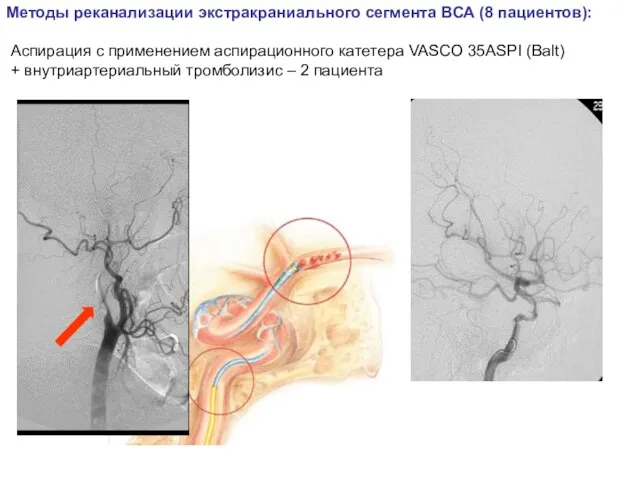 Методы реканализации экстракраниального сегмента ВСА (8 пациентов): Аспирация с применением аспирационного катетера