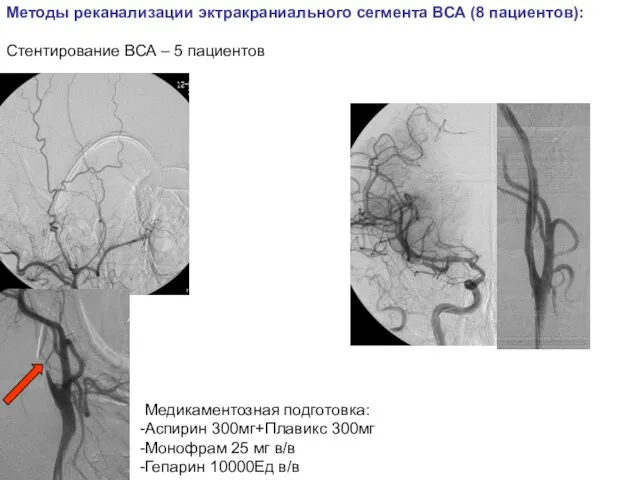 Методы реканализации эктракраниального сегмента ВСА (8 пациентов): Стентирование ВСА – 5 пациентов