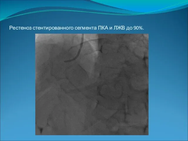 Рестеноз стентированного сегмента ПКА и ЛЖВ до 90%.