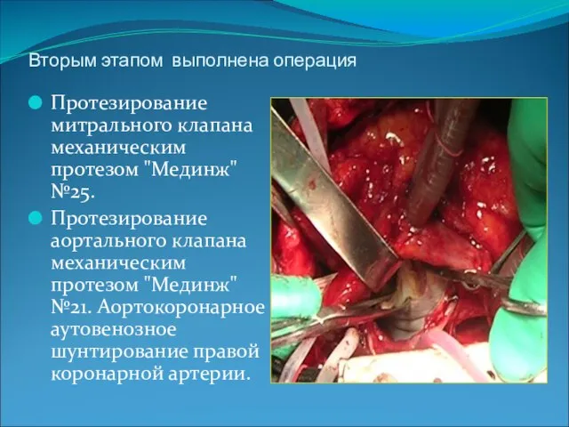 Вторым этапом выполнена операция Протезирование митрального клапана механическим протезом "Мединж" №25. Протезирование