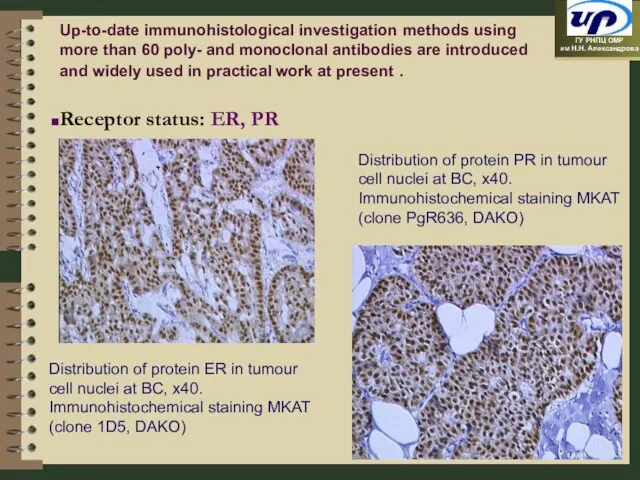 Distribution of protein ER in tumour cell nuclei at BC, x40. Immunohistochemical