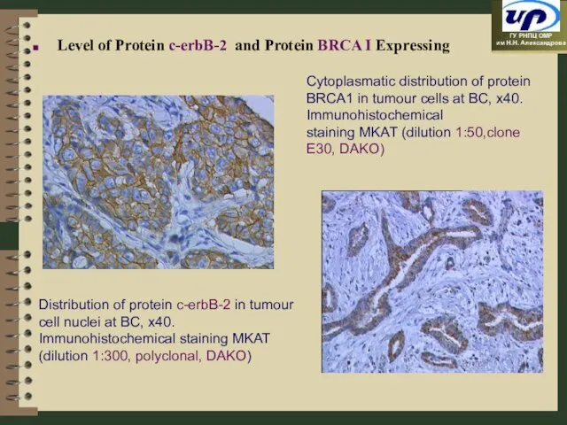 Distribution of protein c-erbB-2 in tumour cell nuclei at BC, x40. Immunohistochemical