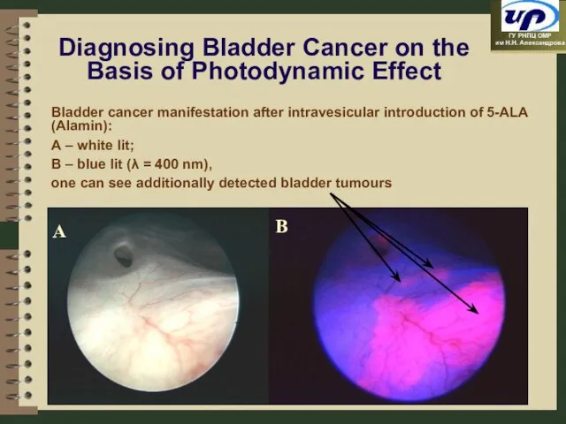 Diagnosing Bladder Cancer on the Basis of Photodynamic Effect Bladder cancer manifestation