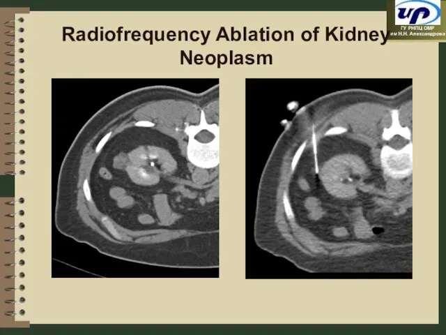 Radiofrequency Ablation of Kidney Neoplasm